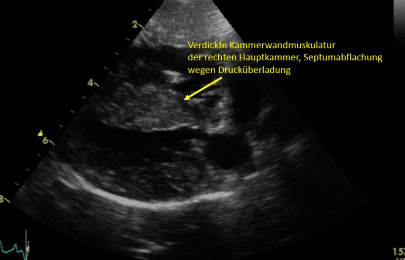 Herzultraschall Langsachse mit Druckuberladung des rechten Herzens
