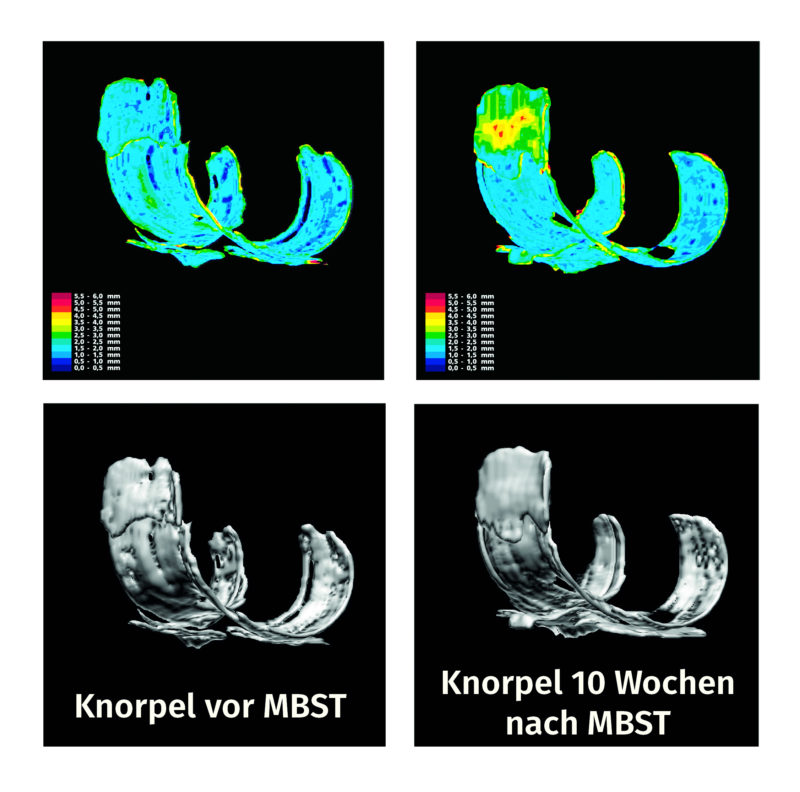 Knorpelzuwachs Mrt Bild