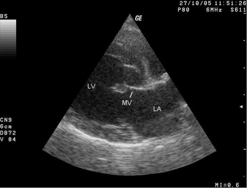 Mitral Valve Endocardiosis