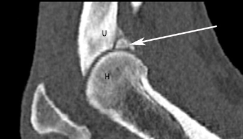 Zahn5 Ct Ellbogen Sagittal Beschriftet